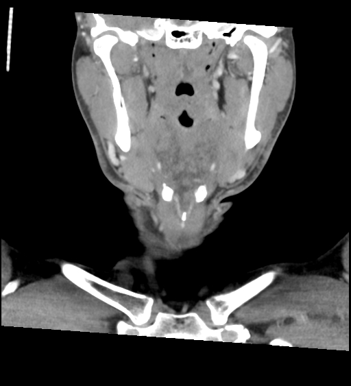 Acute longus colli calcific tendinitis (Radiopaedia 72495-83036 Coronal C+ arterial phase 21).jpg