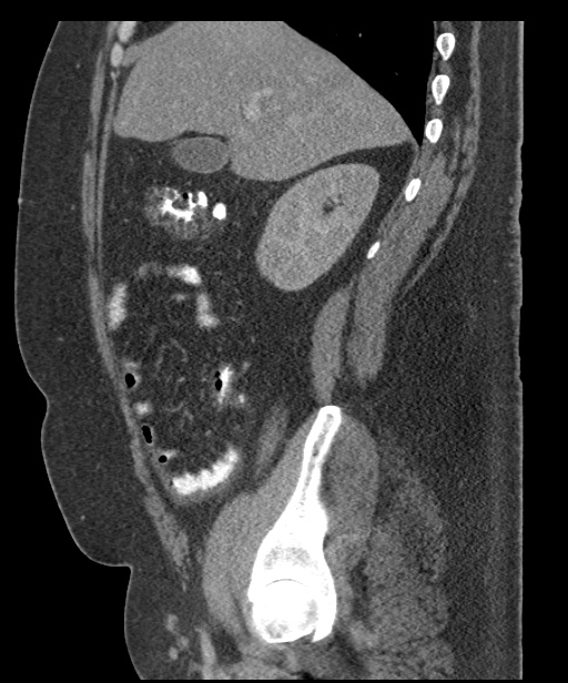 Acute mesenteric venous ischemia (Radiopaedia 46041-50383 Sagittal C+ portal venous phase 32).jpg