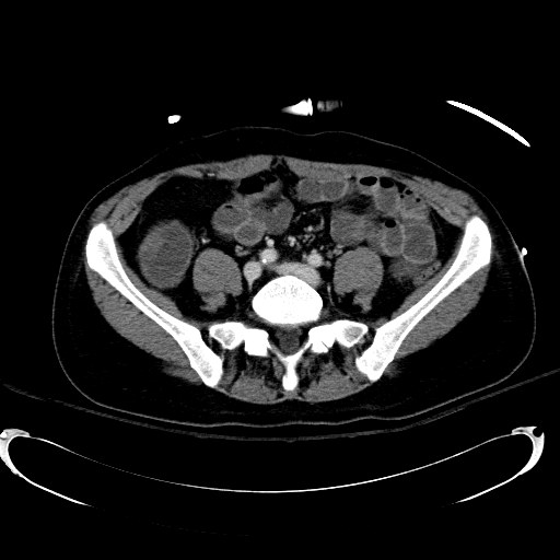 Acute myocardial infarction in CT (Radiopaedia 39947-42415 Axial C+ portal venous phase 89).jpg