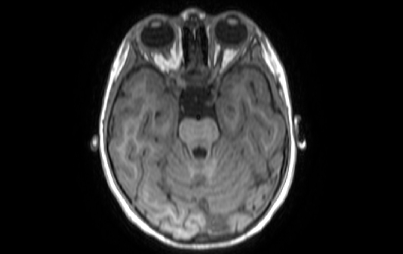 Acute necrotizing encephalitis of childhood (Radiopaedia 67356-76737 Axial T1 66).jpg