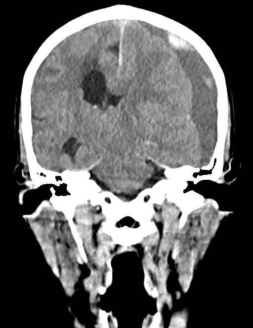 Acute on chronic subdural hematoma (Radiopaedia 74814-85823 Coronal non-contrast 37).jpg