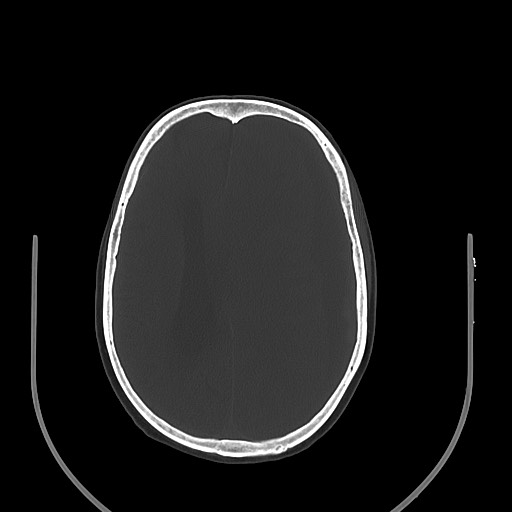 Acute on chronic subdural hematoma (Radiopaedia 74814-85823 D 52).jpg