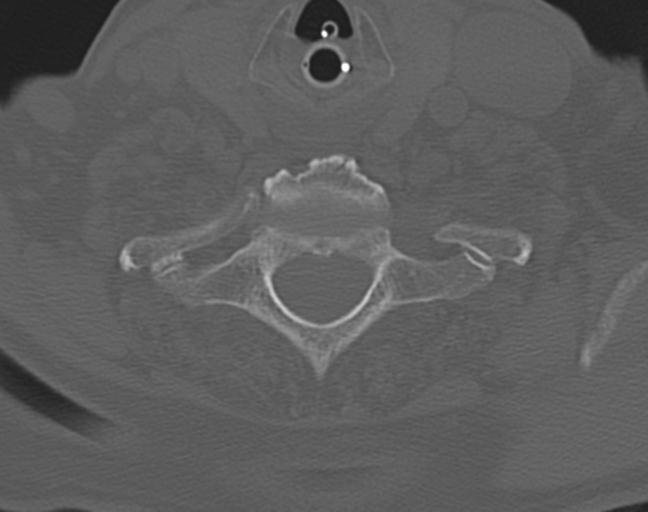 Acute on chronic subdural hematoma and thoracic vertebral injury in a multitrauma patient (Radiopaedia 31698-32619 Axial bone window 49).jpg