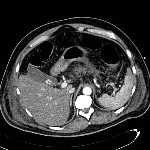 File:Acute pancreatic necrosis (Radiopaedia 13560-13486 Axial C+ portal venous phase 41).jpg