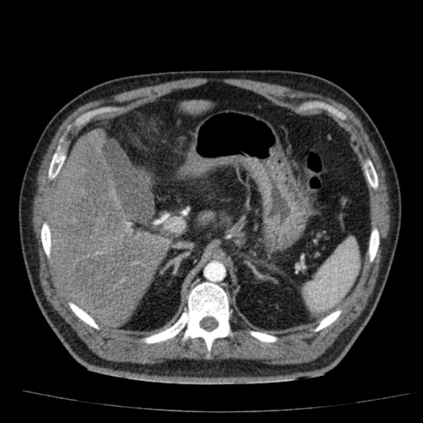 Acute pancreatitis (Radiopaedia 26663-26813 Axial C+ arterial phase 28).jpg