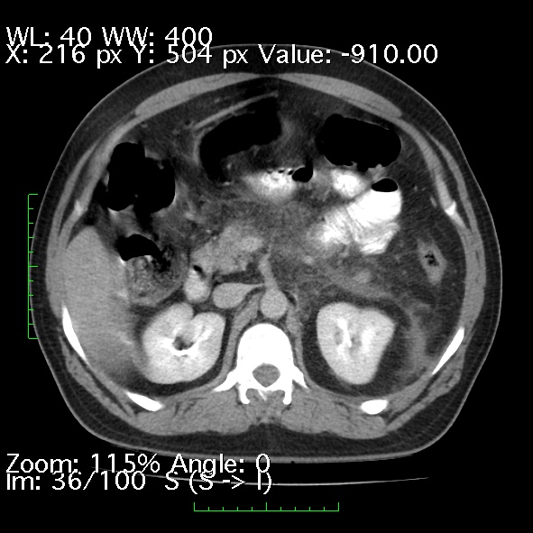 Acute pancreatitis (Radiopaedia 34043-35276 Axial C+ portal venous phase 36).jpg