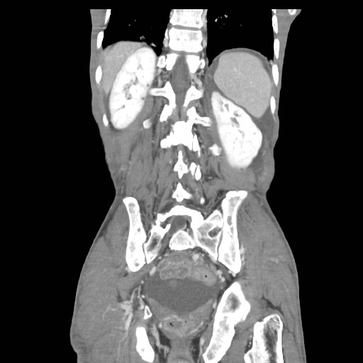 File:Acute pancreatitis (Radiopaedia 50213-55558 Coronal C+ portal venous phase 37).jpg