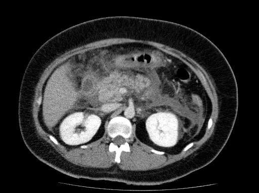 Acute pancreatitis (Radiopaedia 69236-79012 Axial C+ portal venous phase 35).jpg