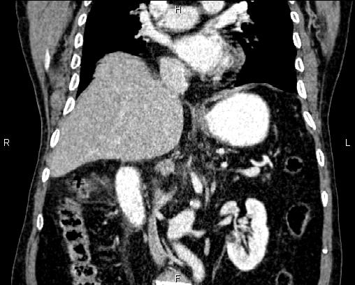 Acute pancreatitis (Radiopaedia 85146-100701 Coronal C+ portal venous phase 41).jpg