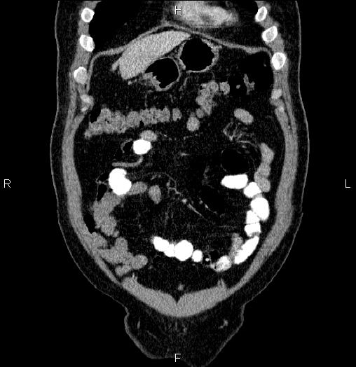 Acute pancreatitis (Radiopaedia 85390-101010 Coronal C+ portal venous phase 10).jpg
