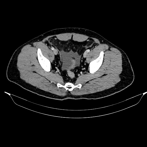 Acute pancreatitis (Radiopaedia 87428-103757 Axial C+ portal venous phase 85).jpg
