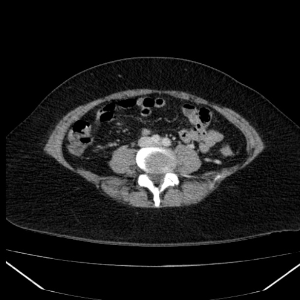 Acute pancreatitis - Balthazar C (Radiopaedia 26569-26714 Axial C+ portal venous phase 63).jpg
