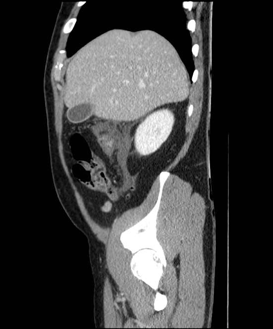 Acute pancreatitis - Balthazar E (Radiopaedia 23080-23110 Sagittal C+ portal venous phase 17).jpg