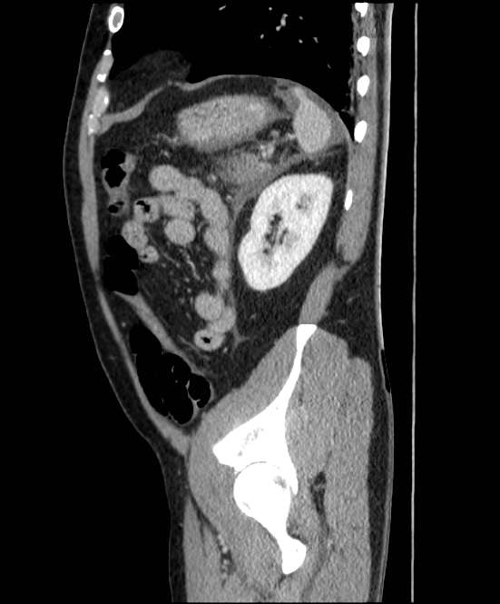 Acute pancreatitis - Balthazar E (Radiopaedia 23080-23110 Sagittal C+ portal venous phase 78).jpg