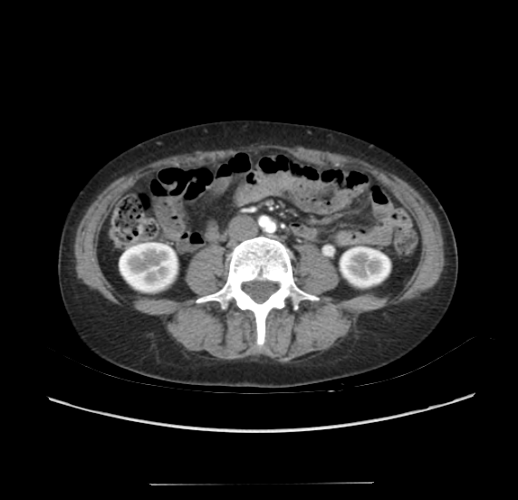 File:Acute pancreatitis - Balthazar E - post ERCP (Radiopaedia 27562-27772 Axial C+ arterial phase 35).png