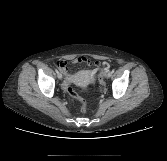 Acute pancreatitis - Balthazar E - post ERCP (Radiopaedia 27562-27772 Axial C+ portal venous phase 67).png