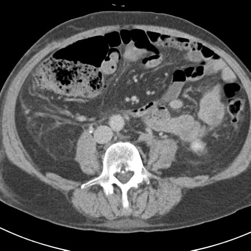 Acute pancreatitis and walled-off necrosis (Radiopaedia 29888-30403 Axial C+ delayed 50).jpg