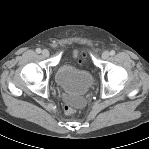 File:Acute pancreatitis and walled-off necrosis (Radiopaedia 29888-30403 Axial C+ delayed 78).jpg