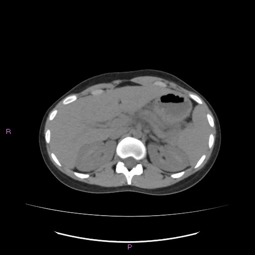 File:Acute pancreatitis secondary to stone at minor papilla and pancreatic divisum (Radiopaedia 76570-88333 Axial non-contrast 21).jpg