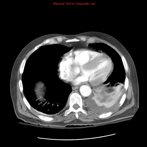 Acute pancreatitis with incidental pancreatic lipoma (Radiopaedia 10190-10730 Axial C+ arterial phase 8).jpg