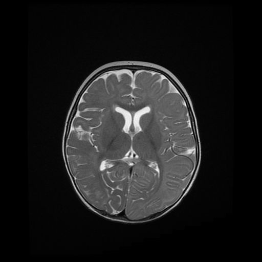 File:Acute phase of hemiconvulsion-hemiplegia epilepsy syndrome (Radiopaedia 29309-29745 Axial T2 11).jpg