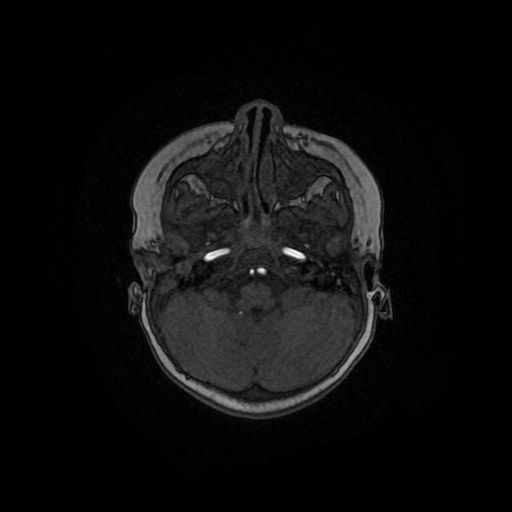 Acute phase of hemiconvulsion-hemiplegia epilepsy syndrome (Radiopaedia 29309-29745 Axial TOF angiography 124).jpg