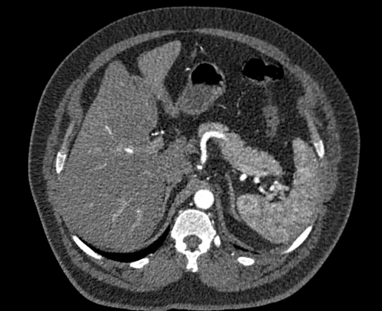 Acute pulmonary embolism with pulmonary infarcts (Radiopaedia 77688-89908 Axial C+ CTPA 74).jpg