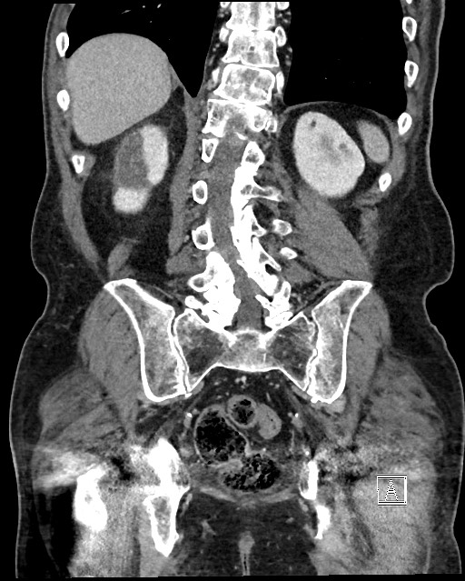 Acute renal infarction - rim capsular enhancement (Radiopaedia 59833-67270 Coronal C+ portal venous phase 48).jpg