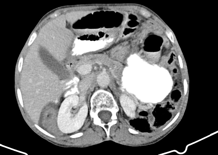 File:Acute small bowel (ileal) volvulus (Radiopaedia 71740-82139 Axial C+ portal venous phase 68).jpg