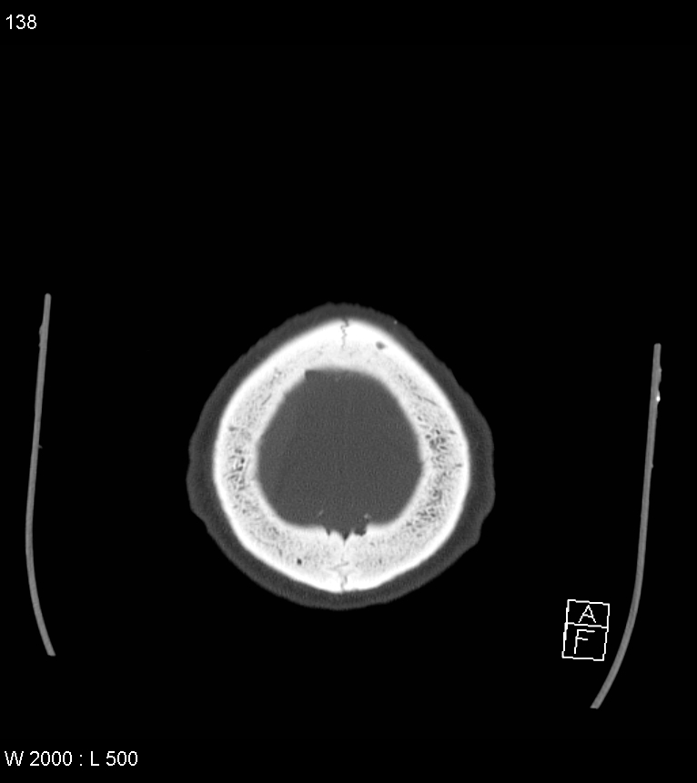 Acute subdural hematoma with myelofibrosis (Radiopaedia 52582-58494 Axial bone window 69).jpg