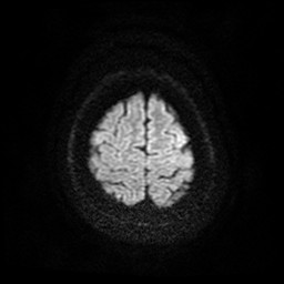 Acute superior cerebellar artery territory infarct (Radiopaedia 84104-99358 Axial DWI 39).jpg
