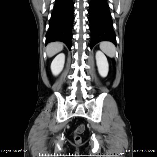 Acute superior mesenteric artery occlusion (Radiopaedia 43636-47060 Coronal C+ portal venous phase 49).jpg
