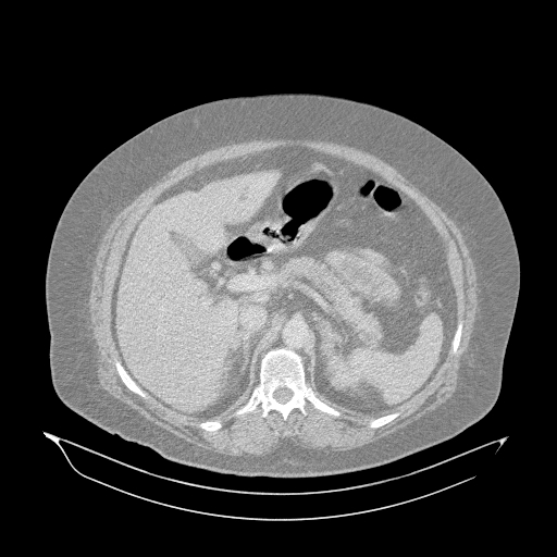 Acute superior mesenteric artery occlusion (Radiopaedia 51288-56960 Axial lung window 10).jpg