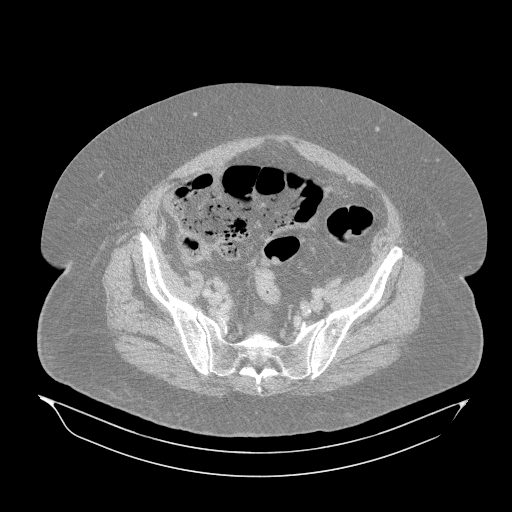 Acute superior mesenteric artery occlusion (Radiopaedia 51288-56960 Axial lung window 59).jpg