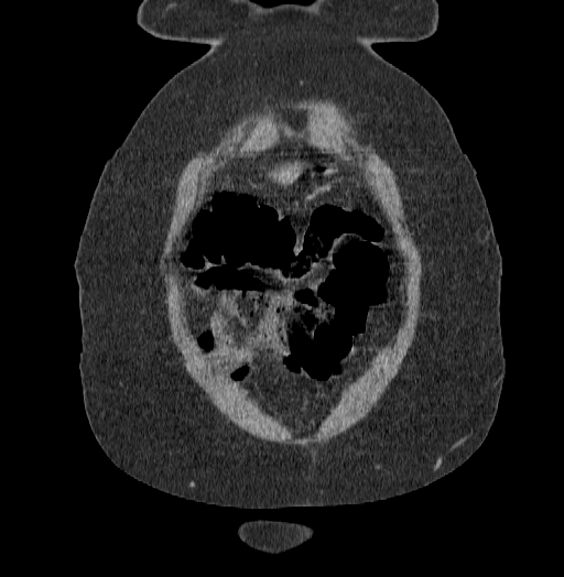 Acute superior mesenteric artery occlusion (Radiopaedia 51288-56960 Coronal C+ portal venous phase 9).jpg
