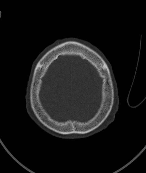 Acute traumatic subdural hematoma (Radiopaedia 82921-97257 Axial bone window 21).jpg