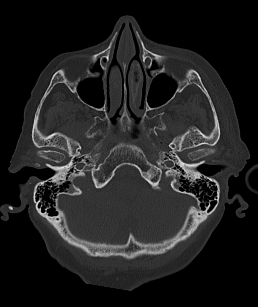Acute traumatic subdural hematoma (Radiopaedia 82921-97257 Axial bone window 88).jpg