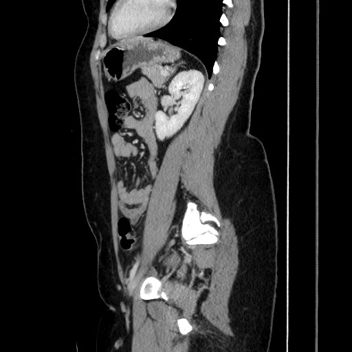Acute uncomplicated appendicitis (Radiopaedia 73704-84499 Sagittal C+ portal venous phase 136).jpg