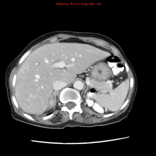 File:Adenocarcinoma of the colon (Radiopaedia 8191-9039 Axial liver window 17).jpg