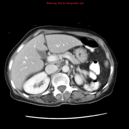 Adenocarcinoma of the colon (Radiopaedia 8191-9039 Axial liver window 24).jpg