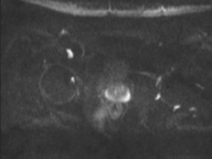 Adenocarcioma of rectum- T1 lesion (Radiopaedia 36921-38546 Axial DWI 40).png