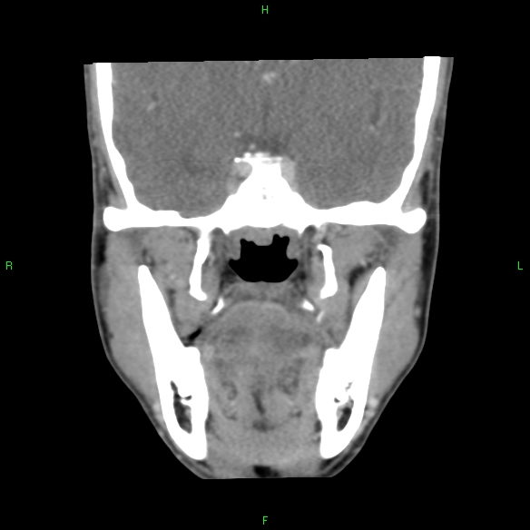File:Adenoid cystic carcinoma of hard palate (Radiopaedia 26137-26273 Coronal liver window 17).jpg
