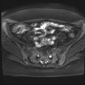 File:Adenomyosis and endometriotic cysts (Radiopaedia 82300-96367 Axial DWI 18).jpg