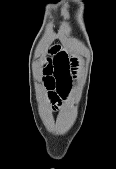Adhesional small bowel obstruction (Radiopaedia 52107-57980 Coronal C+ portal venous phase 6).jpg