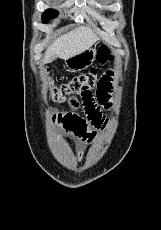 Adhesional small bowel obstruction (Radiopaedia 58900-66131 Coronal C+ portal venous phase 70).jpg