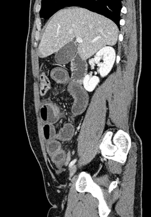 Adhesional small bowel obstruction (Radiopaedia 58900-66131 Sagittal C+ portal venous phase 85).jpg