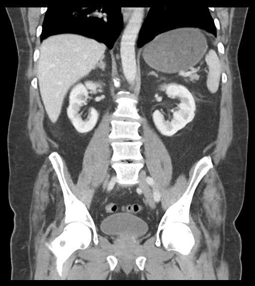 Adhesions within abdominal wall hernia (Radiopaedia 58283-65394 Coronal C+ portal venous phase 44).png