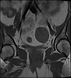 File:Adnexal multilocular cyst (O-RADS US 3- O-RADS MRI 3) (Radiopaedia 87426-103754 Coronal 16).jpg