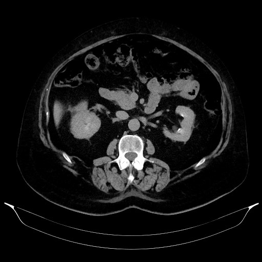 Adrenal cortical carcinoma (Radiopaedia 64017-72769 Axial C+ delayed 32).jpg