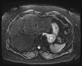 Adrenal cortical carcinoma (Radiopaedia 64017-72770 Axial DWI 4).jpg
